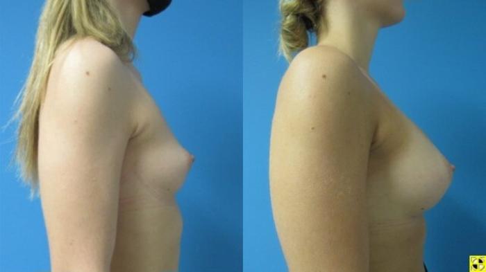 Before & After Breast Augmentation Case 15 View 3 View in Savannah, GA