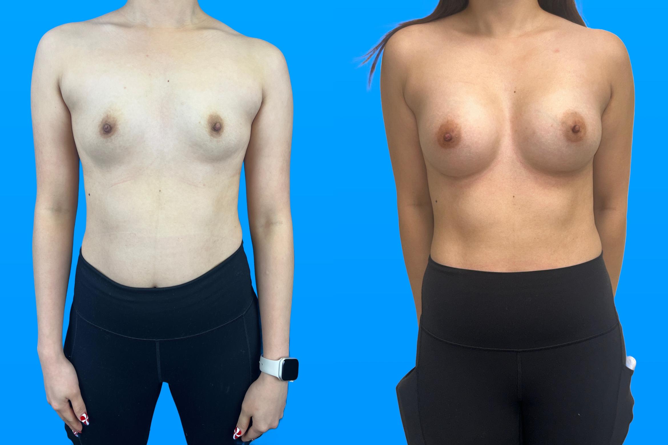 Before & After Breast Augmentation Case 157 Front View in Savannah, GA