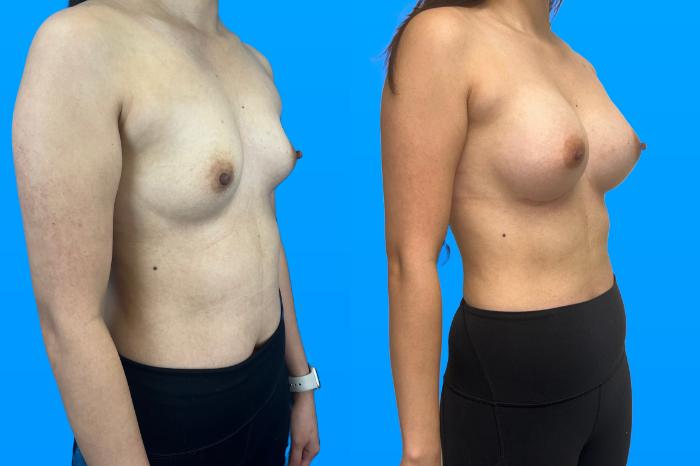 Before & After Breast Augmentation Case 157 Right Side View in Savannah, GA
