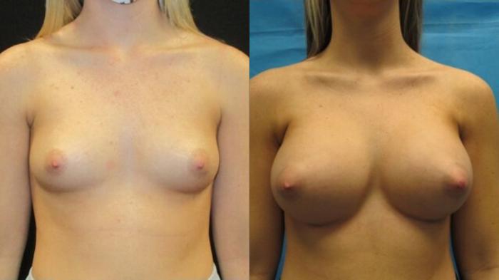 Before & After Breast Augmentation Case 16 View 1 View in Savannah, GA