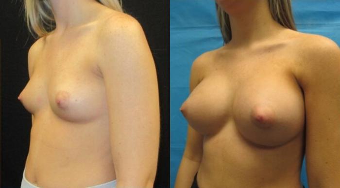 Before & After Breast Augmentation Case 16 View 2 View in Savannah, GA