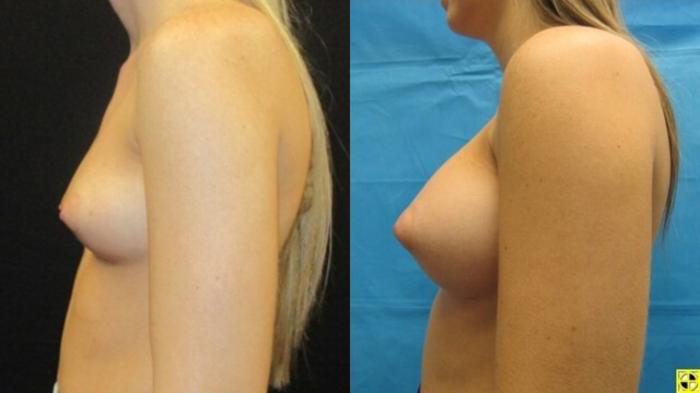 Before & After Breast Augmentation Case 16 View 3 View in Savannah, GA