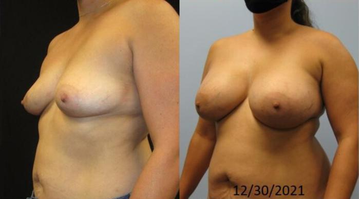 Before & After Breast Augmentation Case 17 View 2 View in Savannah, GA