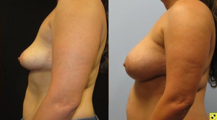 Before & After Breast Augmentation Case 17 View 3 View in Savannah, GA