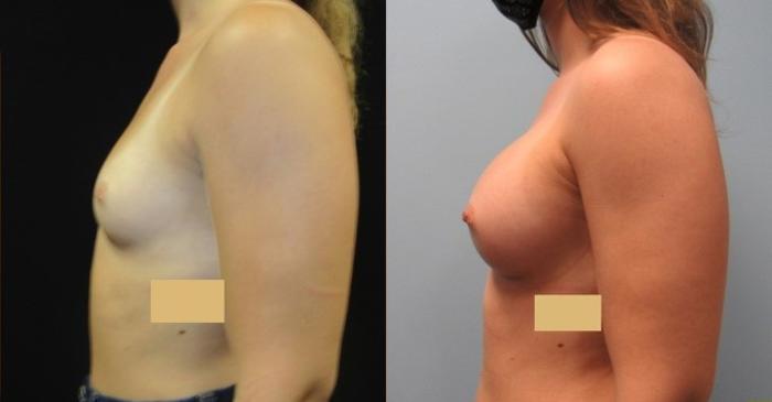 Before & After Breast Augmentation Case 18 View 2 View in Savannah, GA