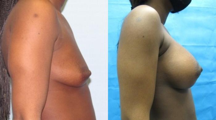 Before & After Breast Augmentation Case 19 View 2 View in Savannah, GA