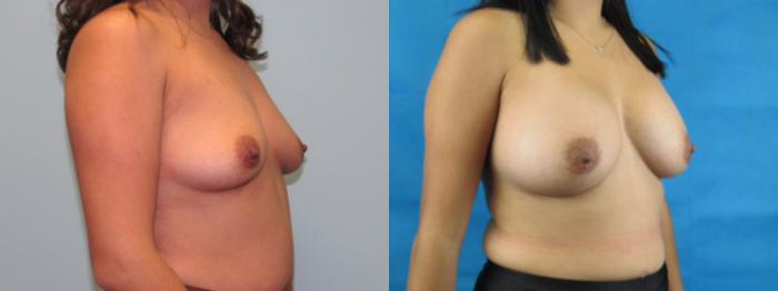 Before & After Breast Augmentation Case 2 View 2 View in Savannah, GA