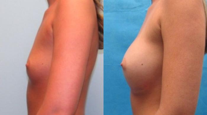Before & After Breast Augmentation Case 20 View 2 View in Savannah, GA