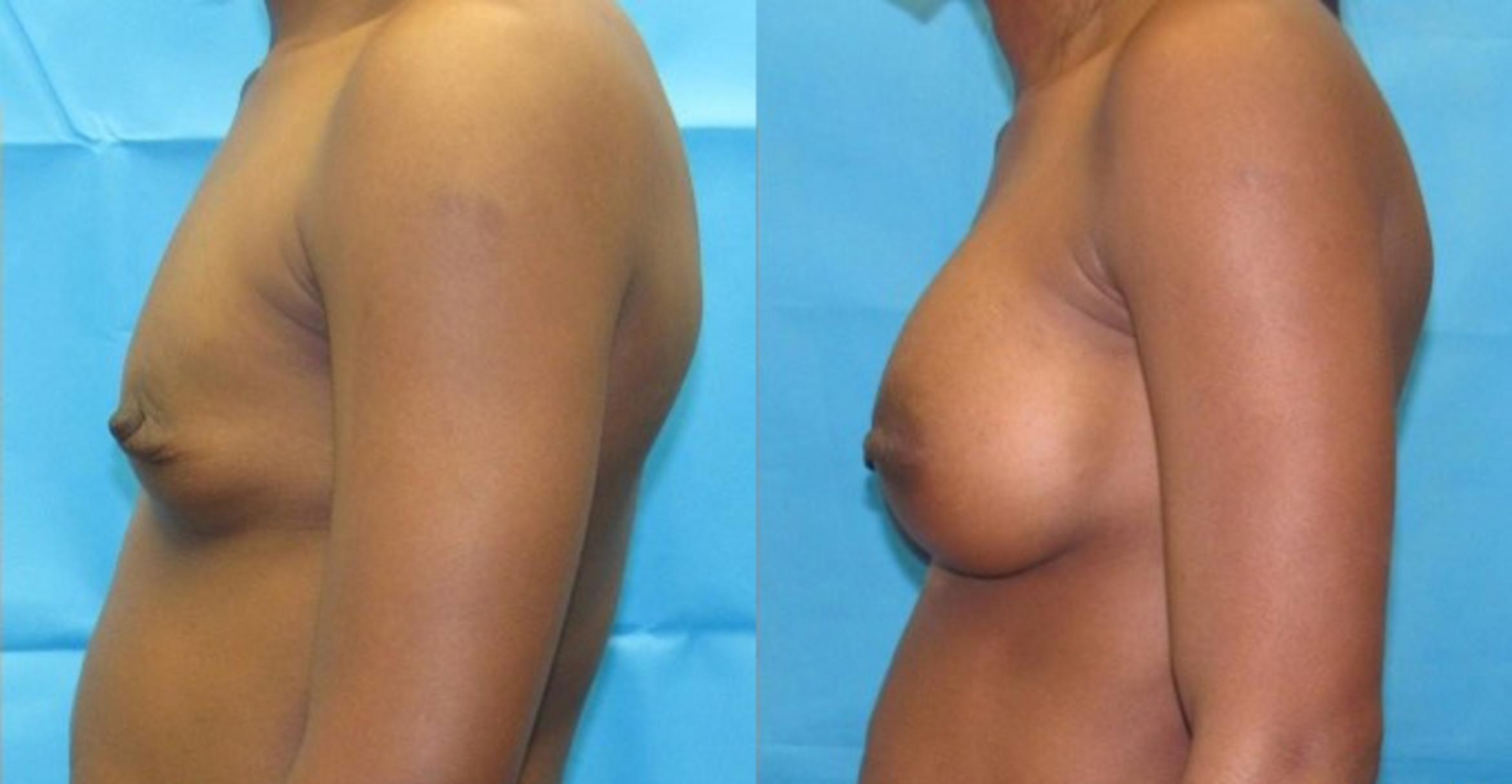 Before & After Breast Augmentation Case 21 View 2 View in Savannah, GA