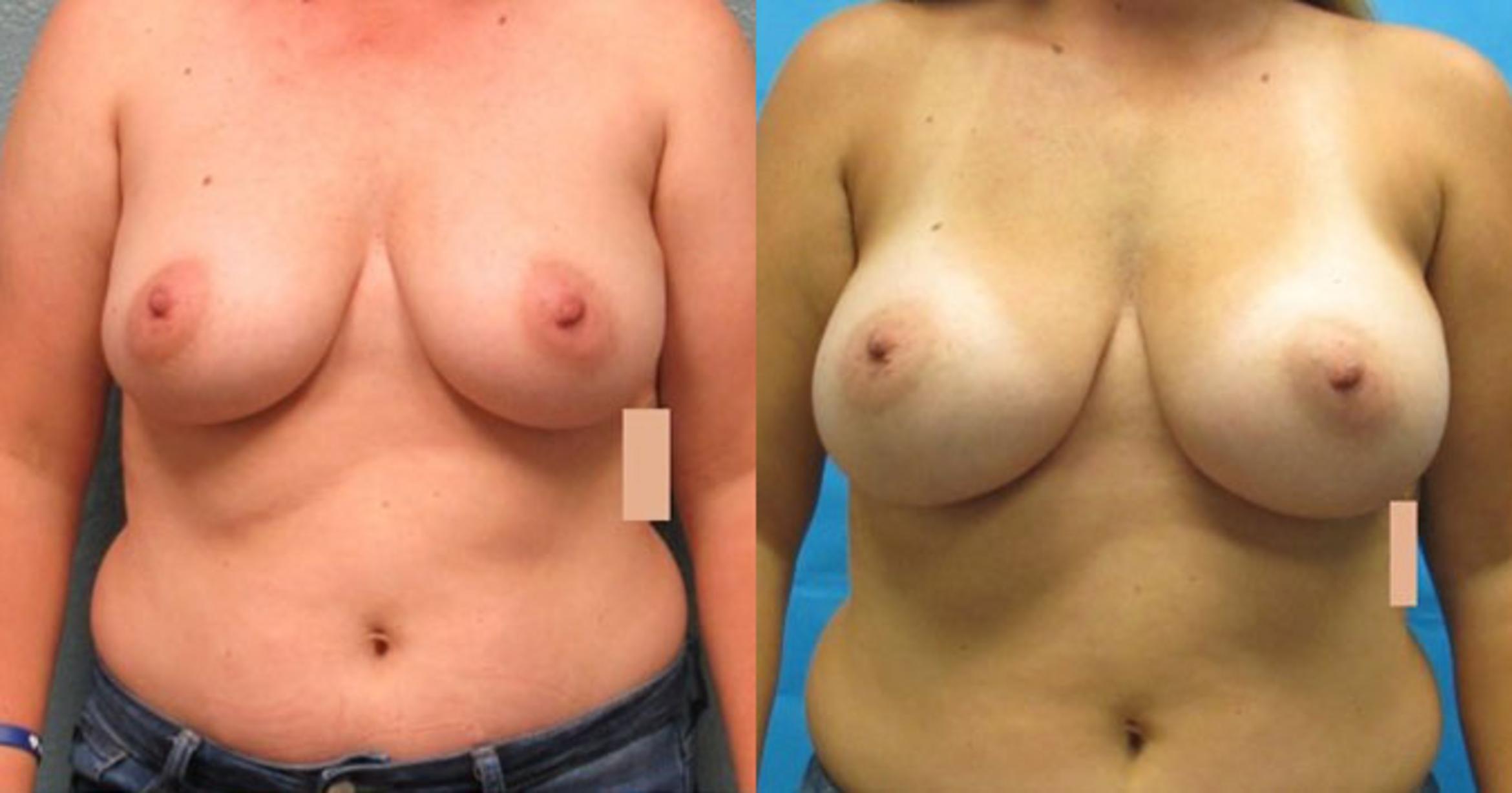 Before & After Breast Augmentation Case 22 View 1 View in Savannah, GA