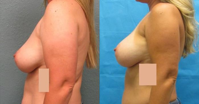 Before & After Breast Augmentation Case 22 View 2 View in Savannah, GA