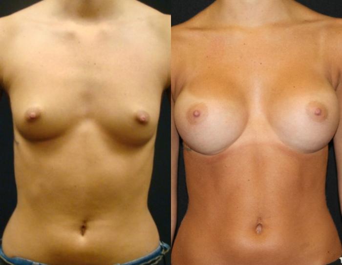 Before & After Breast Augmentation Case 26 View 1 View in Savannah, GA