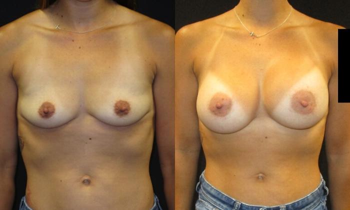 Before & After Breast Augmentation Case 27 View 1 View in Savannah, GA