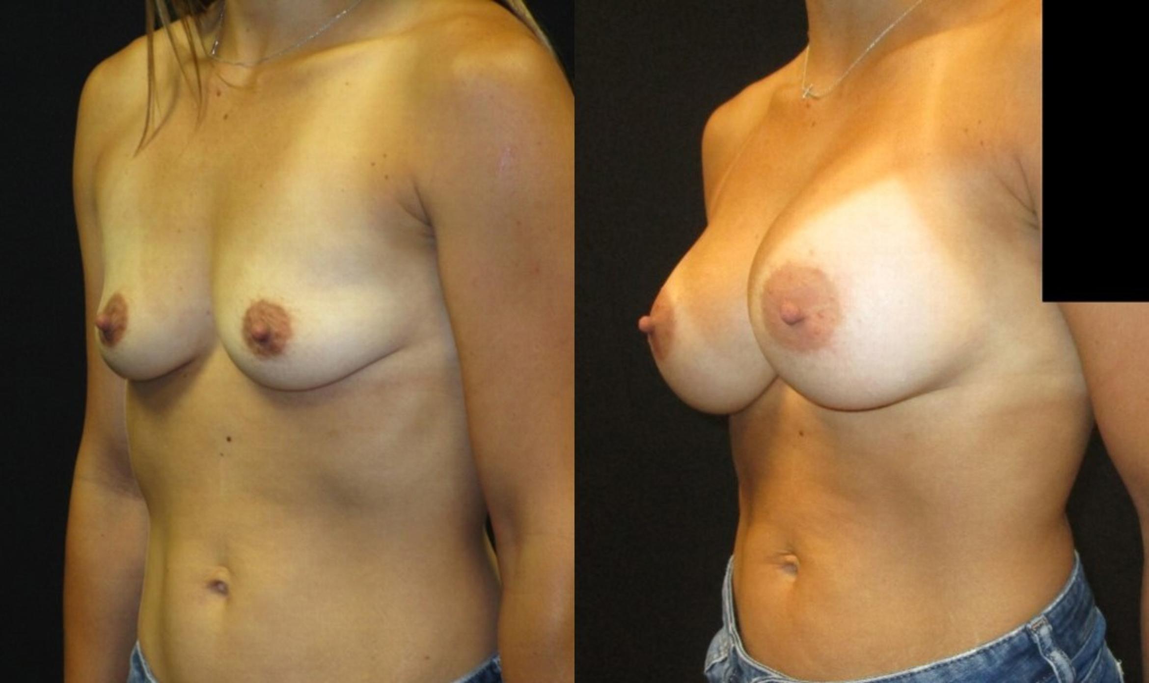 Before & After Breast Augmentation Case 27 View 2 View in Savannah, GA