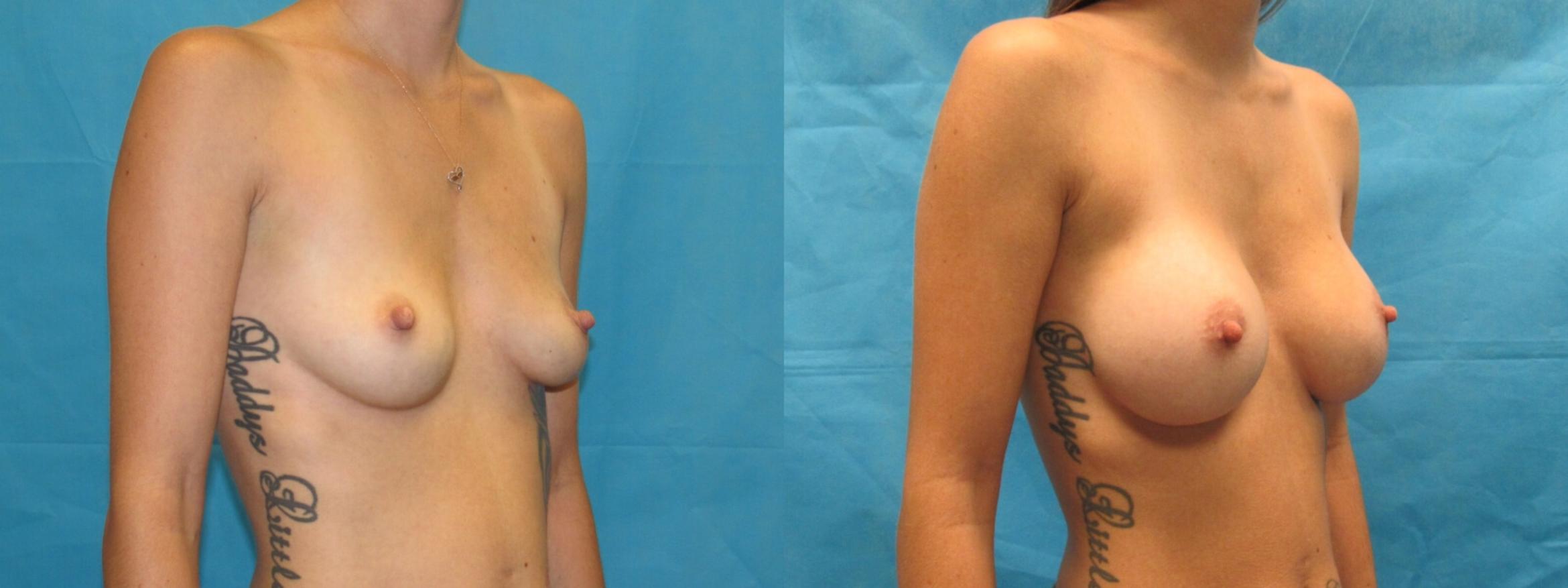 Before & After Breast Augmentation Case 3 View 2 View in Savannah, GA