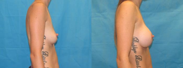 Before & After Breast Augmentation Case 3 View 3 View in Savannah, GA