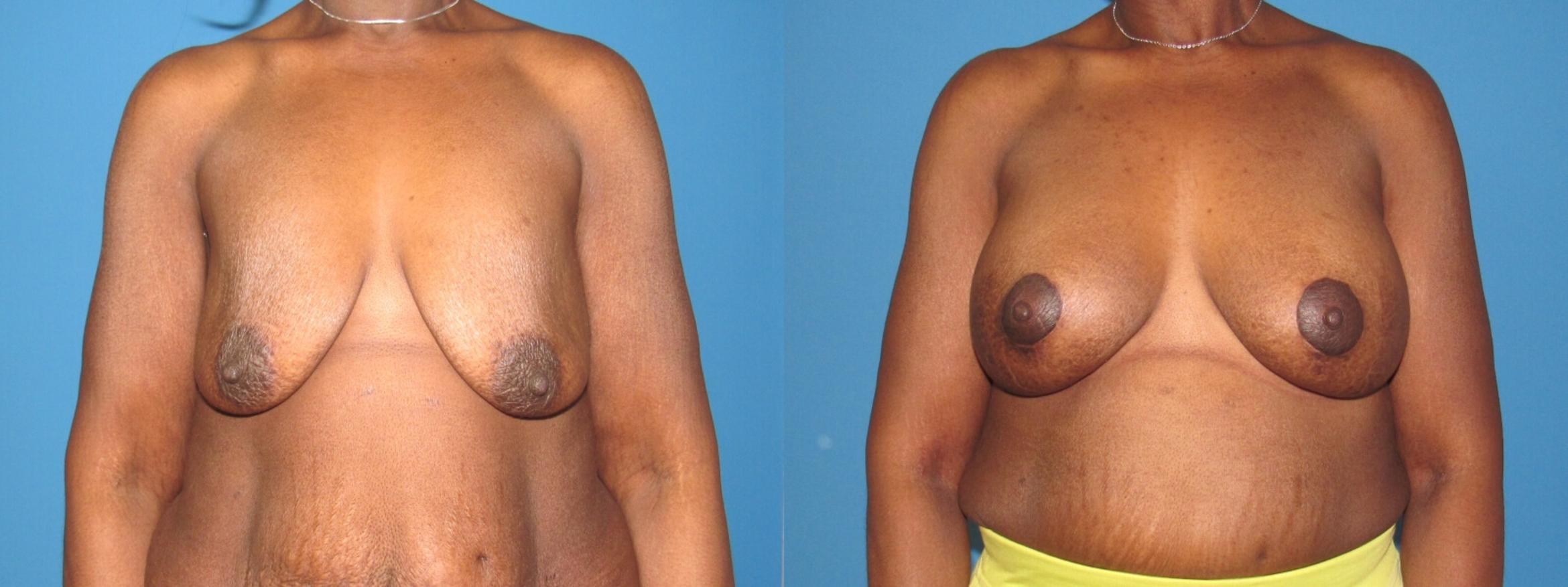 Before & After Breast Augmentation Case 31 View 1 View in Savannah, GA