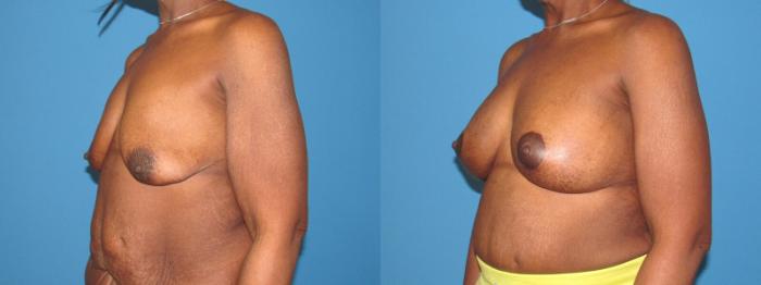 Before & After Breast Augmentation Case 31 View 2 View in Savannah, GA