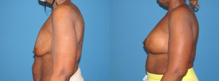 Before & After Breast Augmentation Case 31 View 3 View in Savannah, GA