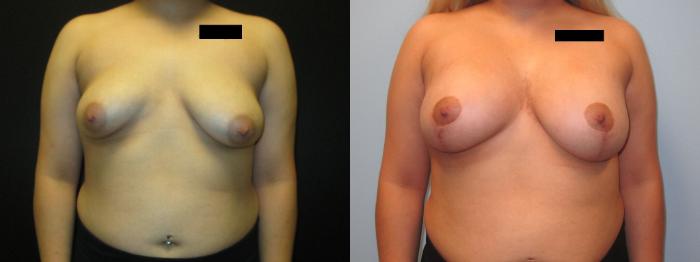 Before & After Breast Augmentation Case 36 View 1 View in Savannah, GA