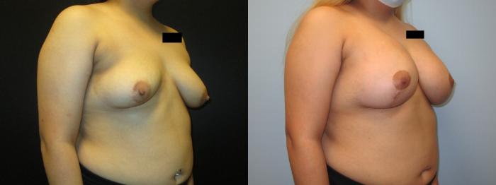 Before & After Breast Augmentation Case 36 View 2 View in Savannah, GA
