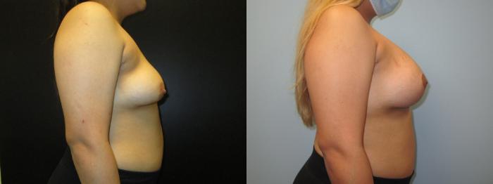 Before & After Breast Augmentation Case 36 View 3 View in Savannah, GA
