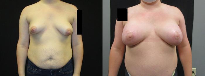 Before & After Breast Augmentation Case 37 View 1 View in Savannah, GA