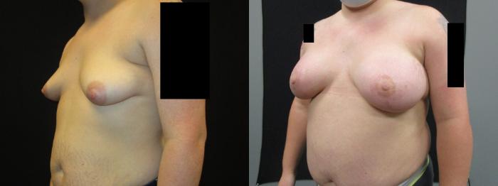 Before & After Breast Augmentation Case 37 View 2 View in Savannah, GA