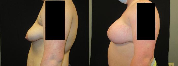 Before & After Breast Augmentation Case 37 View 3 View in Savannah, GA