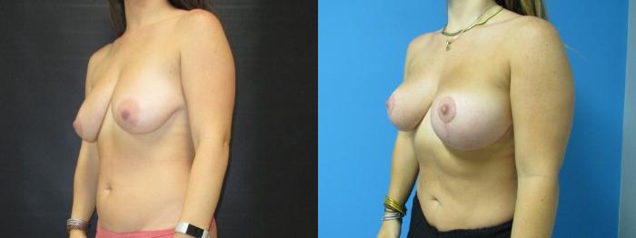 Before & After Breast Augmentation Case 38 View 2 View in Savannah, GA