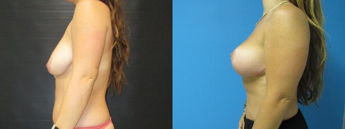 Before & After Breast Augmentation Case 38 View 3 View in Savannah, GA