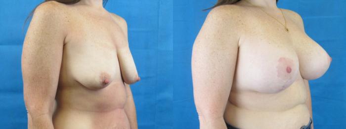 Before & After Breast Augmentation Case 5 View 2 View in Savannah, GA