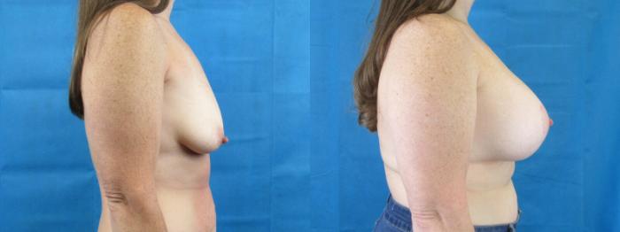 Before & After Breast Augmentation Case 5 View 3 View in Savannah, GA