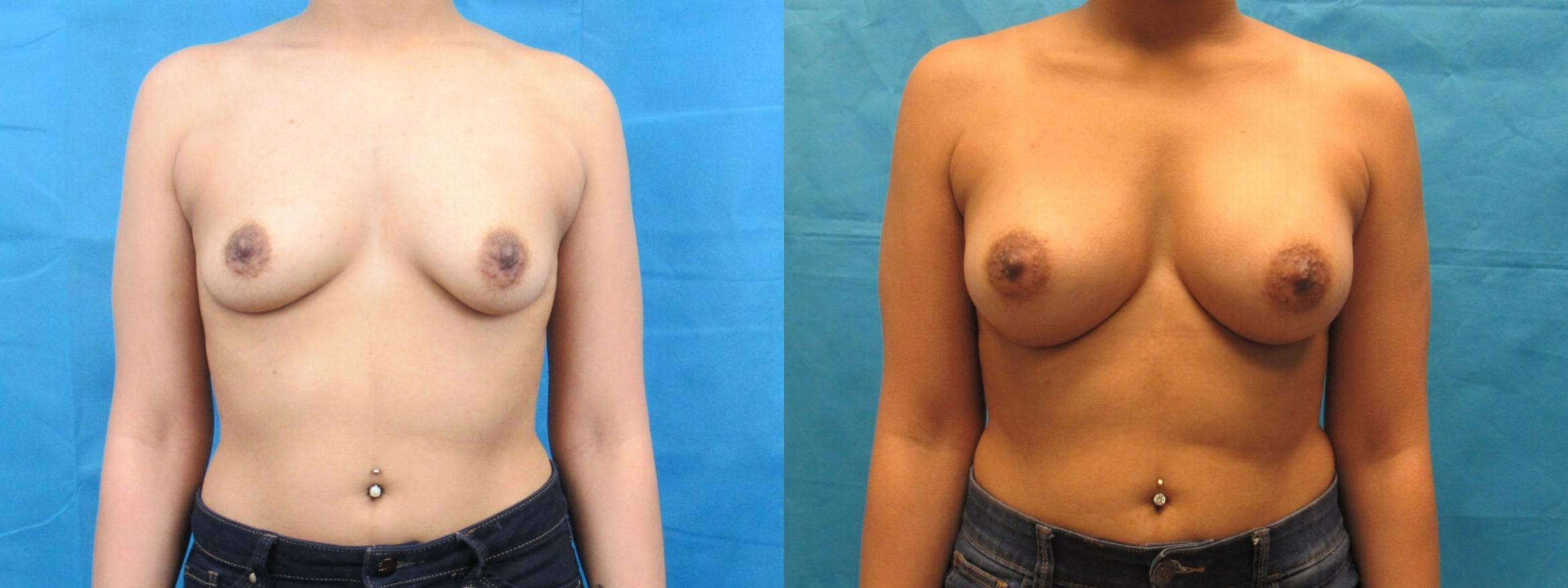 Before & After Breast Augmentation Case 6 View 1 View in Savannah, GA