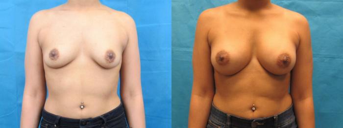 Before & After Breast Augmentation Case 6 View 1 View in Savannah, GA