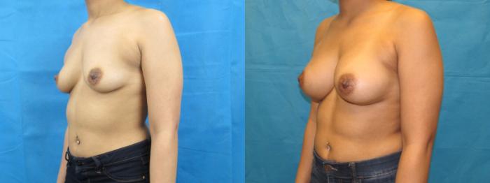 Before & After Breast Augmentation Case 6 View 2 View in Savannah, GA