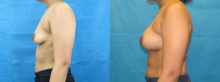 Before & After Breast Augmentation Case 6 View 3 View in Savannah, GA