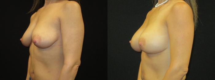 Before & After Breast Augmentation Case 7 View 2 View in Savannah, GA