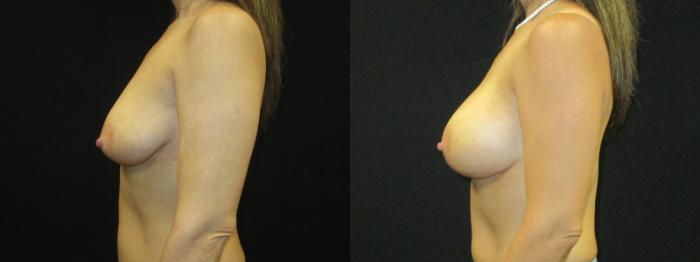 Before & After Breast Augmentation Case 7 View 3 View in Savannah, GA