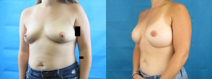 Before & After Breast Augmentation Case 8 View 2 View in Savannah, GA