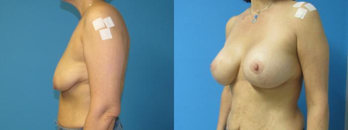 Before & After Breast Lift Case 29 View 2 View in Savannah, GA