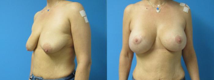 Before & After Breast Lift Case 29 View 3 View in Savannah, GA