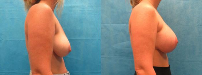 Before & After Breast Lift Case 30 View 2 View in Savannah, GA