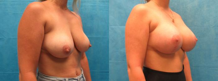 Before & After Breast Lift Case 30 View 3 View in Savannah, GA