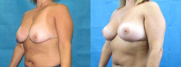 Before & After Breast Lift Case 34 View 2 View in Savannah, GA