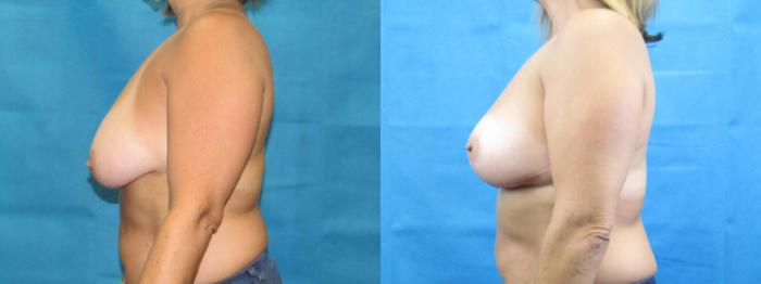 Before & After Breast Lift Case 34 View 3 View in Savannah, GA