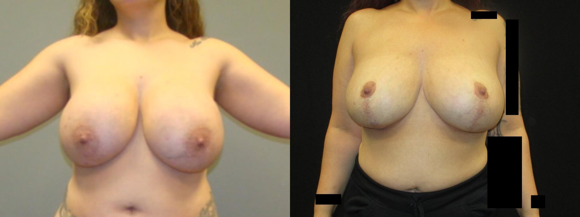 Before & After Breast Lift Case 35 View 1 View in Savannah, GA