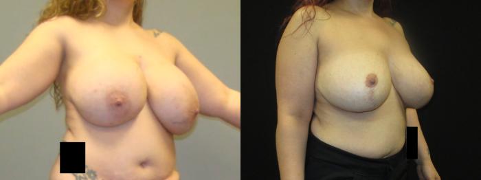 Before & After Breast Lift Case 35 View 2 View in Savannah, GA