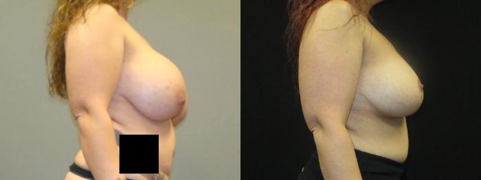 Before & After Breast Lift Case 35 View 3 View in Savannah, GA