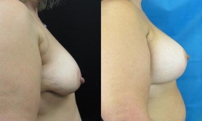 Before & After Breast Lift Case 41 View 3 View in Savannah, GA
